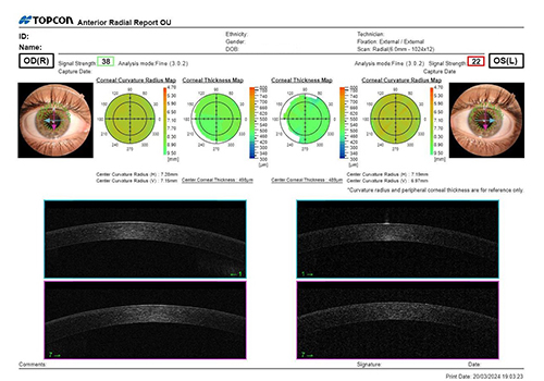 Paquimetría corneal