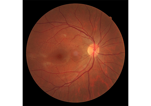 Retinografia